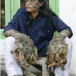 TopRarestDiseasesintheWorld