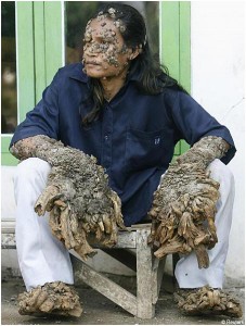 TopRarestDiseasesintheWorld