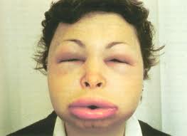TopRarestDiseasesintheWorld