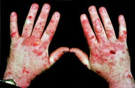 TopRarestDiseasesintheWorld
