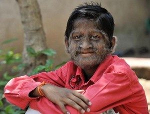 Werewolf Syndrome | Yina Werewolf Syndrome