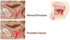 TopMostCommonCancerTypes