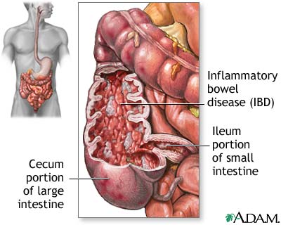 Crohn Disease