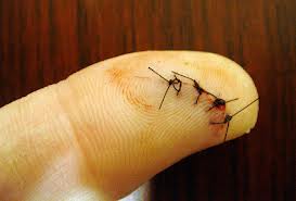 tetanus