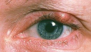TopCommonEyeProblems