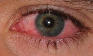 TopCommonEyeProblems