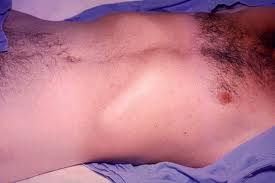 Typhoid Fever
