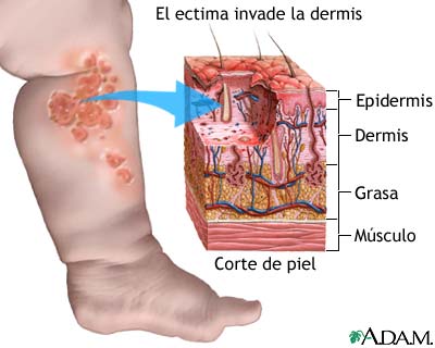 Hidradenitis suppurativa