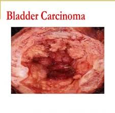 TopMostCommonCancerTypes