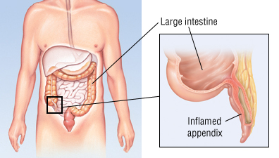 Appendicitis