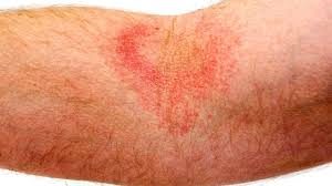 7 Allergic Reactions | Yina TopNegativeEffectsofUsingCosmeticsandMakeupDaily