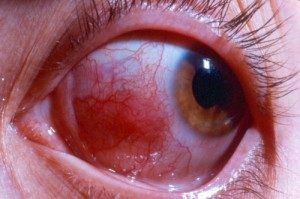 TopCommonEyeProblems
