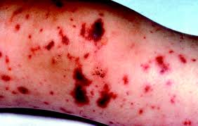 meningitis