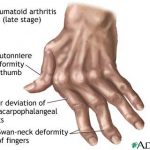 Arthritis