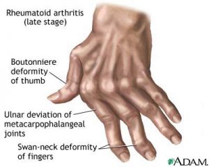 Arthritis