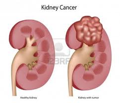 TopMostCommonCancerTypes
