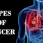 A to Z List of Cancer Types