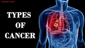 A to Z List of Cancer Types